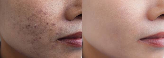 ANTI FRECKLE SOLUTION